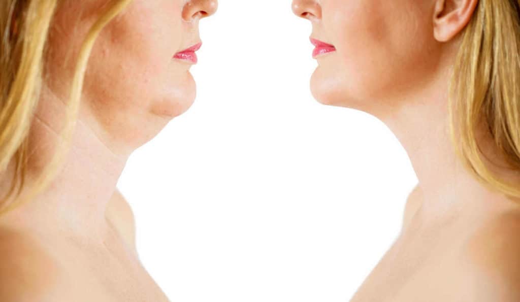 Double Chin treatment Hampton Court before and after results