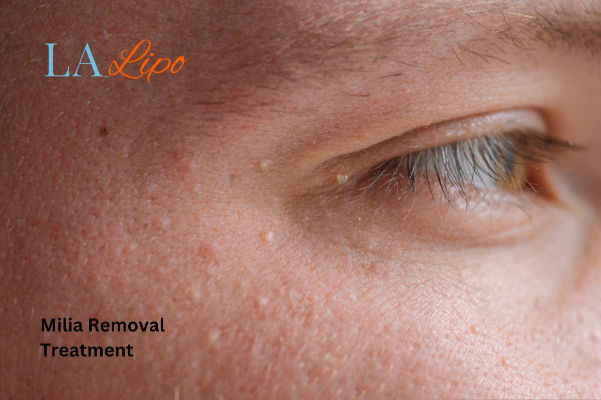 Cryopen Milia Removal: Is It the Easiest and Safest Option Hampton Court?