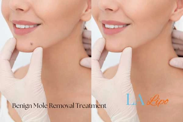 Before and after mole removal Hampton Court treatment