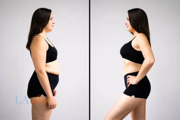 image of woman before and after results of LA-EMS Body Sculpting Hampton Court to help treat Diastasis recti