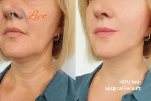 hi-fu for wrinkles Hampton Court before and after results