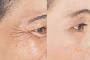 Before and after results of woman - HI-fu wrinkles reduction treatment Hampton Court