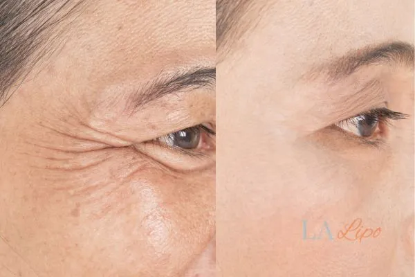 Before and after results of woman - HI-fu wrinkles reduction treatment Hampton Court