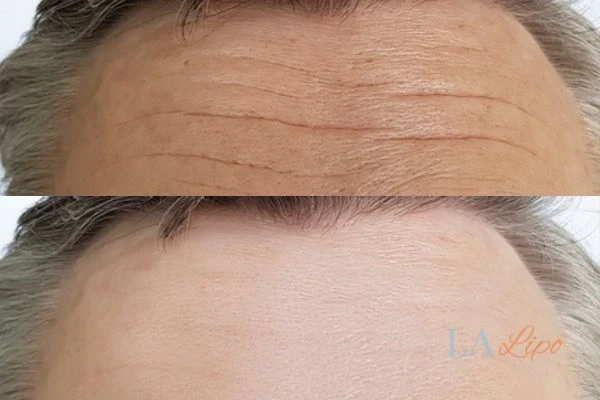 results of HIFU Hampton Court on mans forehead to help reduce lines and wrinkles
