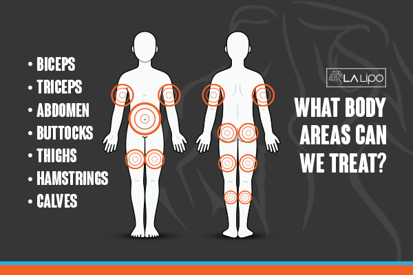 Graphic to show areas you can have LA-EMS Body Sculpting Hampton Court treatment.
