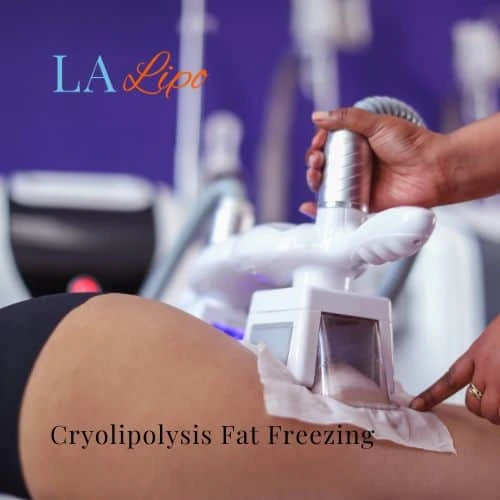 fat freezing - Cryolipolysis Hampton Court