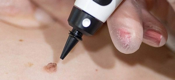 skin tag removal using cryopen Hampton Court