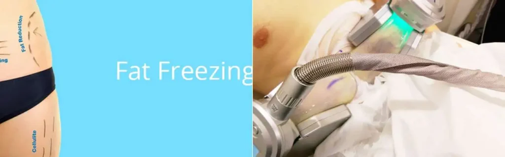 Fat freezing Hampton Court on multiple areas of the body