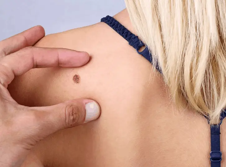 woman having mole removal Hampton Court consultation before treatment.