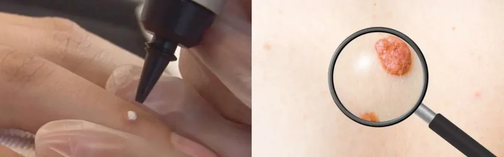 Cryopen for mole removal Hampton Court - speak to our team today!