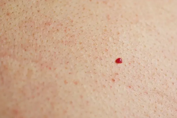 close up of a cherry angioma Hampton Court