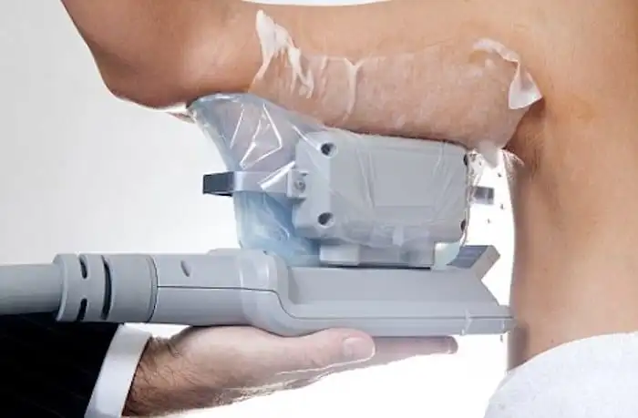 Picture of fat freezing Hampton Court on the upper arms.