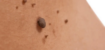 image of a skin tag Hampton Court