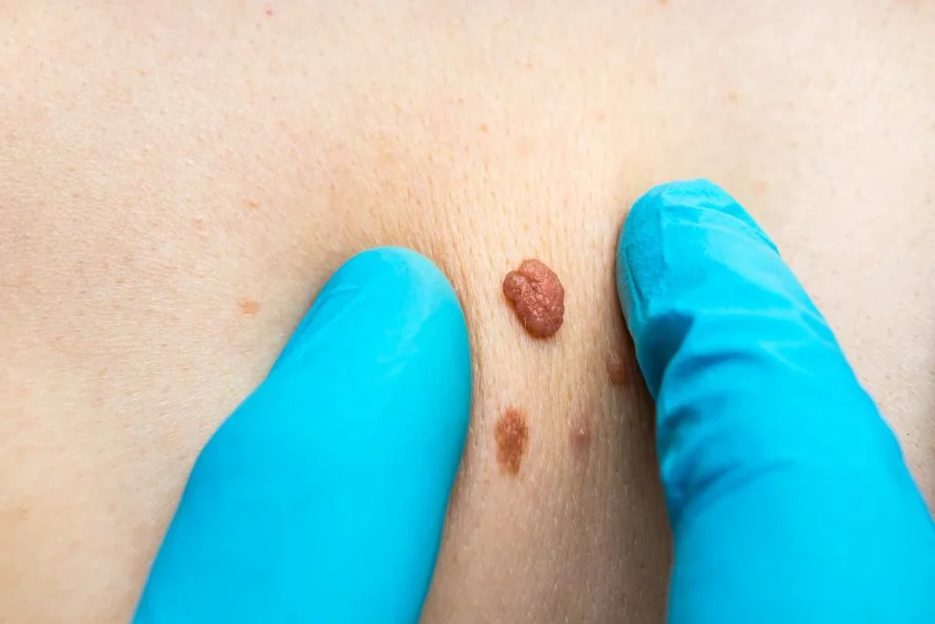 Consultant examining a skin tag Hampton Court
