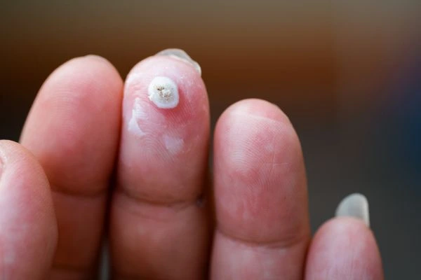 wart on person finger - cryotherapy to treat from LA LIPO Hampton Court