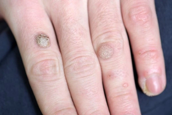 photo of warts on person hand - see wart removal Hampton Court from LA LIPO