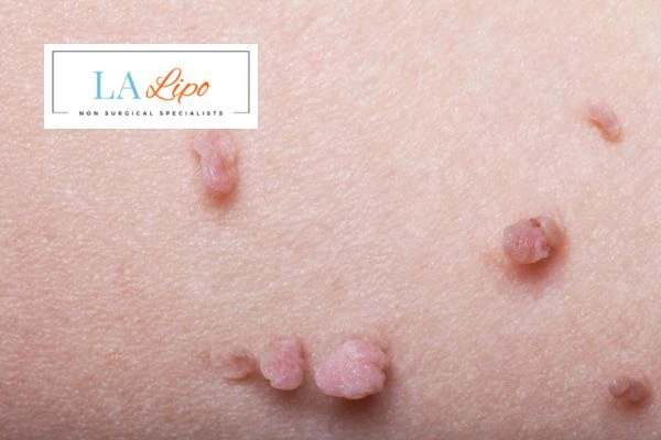 Does cryopen skin tag removal Hampton Court hurt? Find out now call our team today!