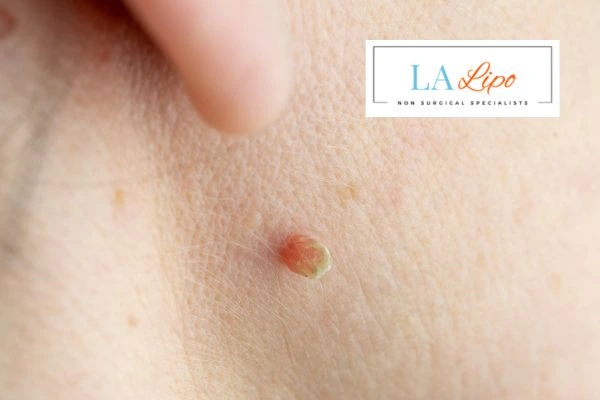 Book skin tag removal Hampton Court today speak to our team now!