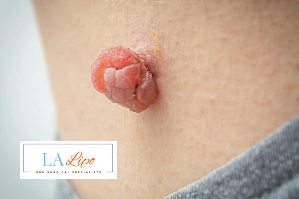 Interested in skin tag removal Hampton Court? Concerned about the pain? Find out more today!