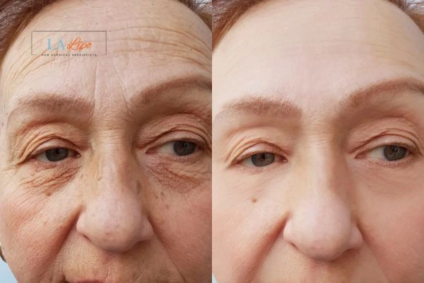 The powerful benefits of Morpheus8 Treatment Hampton Court - Call Our team today!