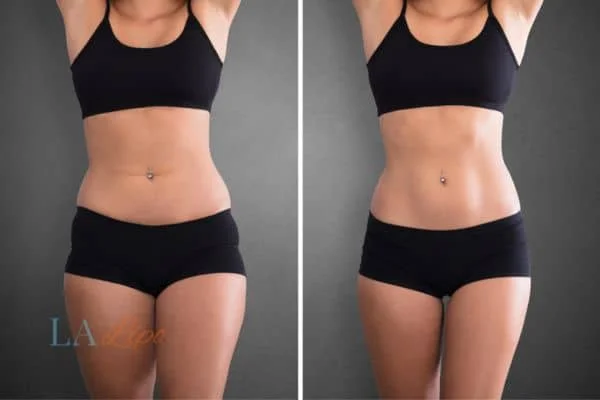 before and after results of non-surgical treatment to help a woman's body image and mental health Hampton Court