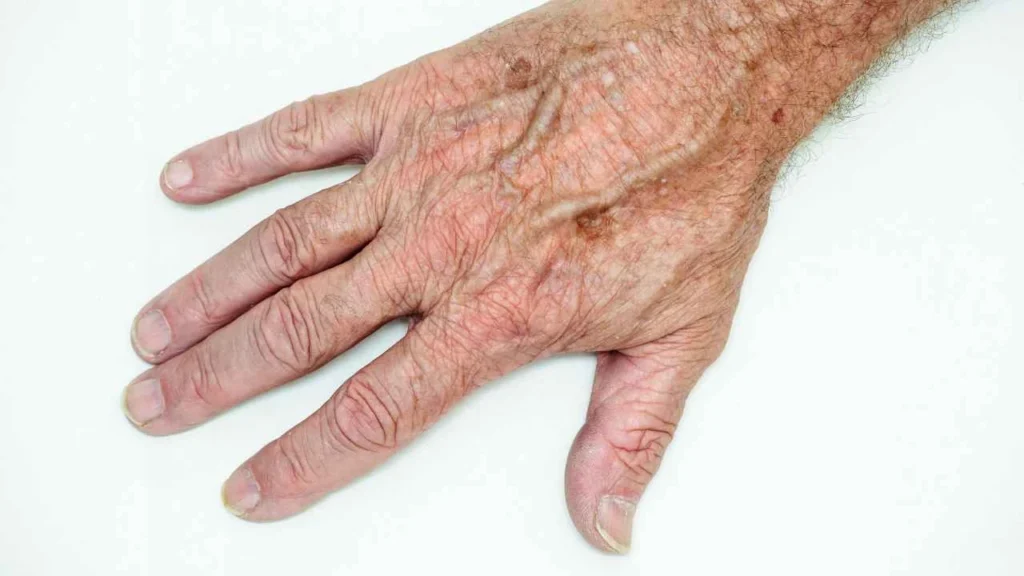 Male hand showing age spot Hampton Court