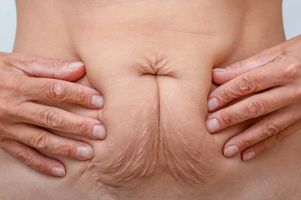 Image of a woman's stomach with loose skin - example of skin tightening Hampton Court options