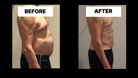 What Symptoms Can Diastasis Recti Cause in Men? Weak Core, Back Pain and Poor Posture Hampton Court